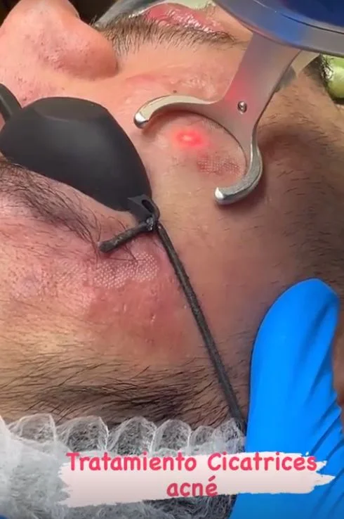 Resultado de tratamiento de acné - Bioestimulación