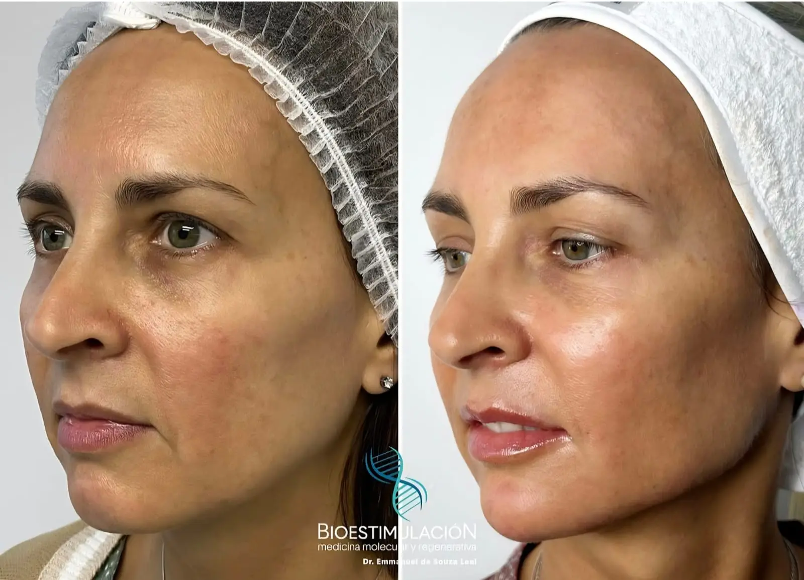 Tratamiento de ácido hialurónico en Montevideo – Bioestimulación