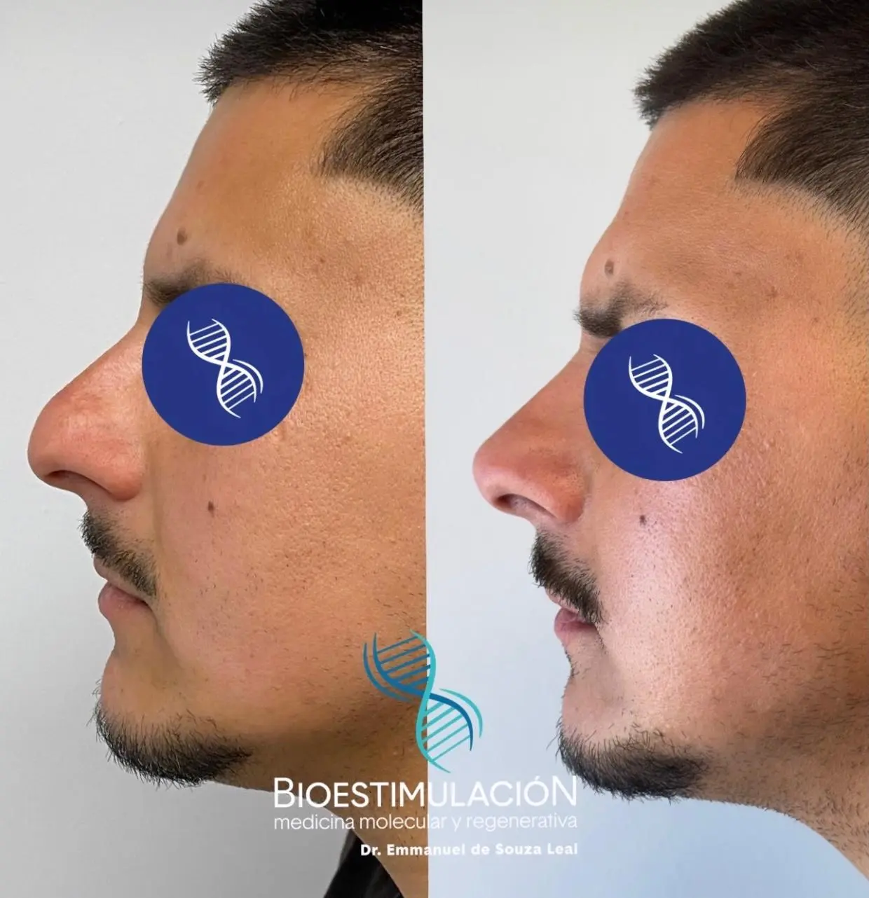 Tratamiento de Rinomodelación masculina - Bioestimulación