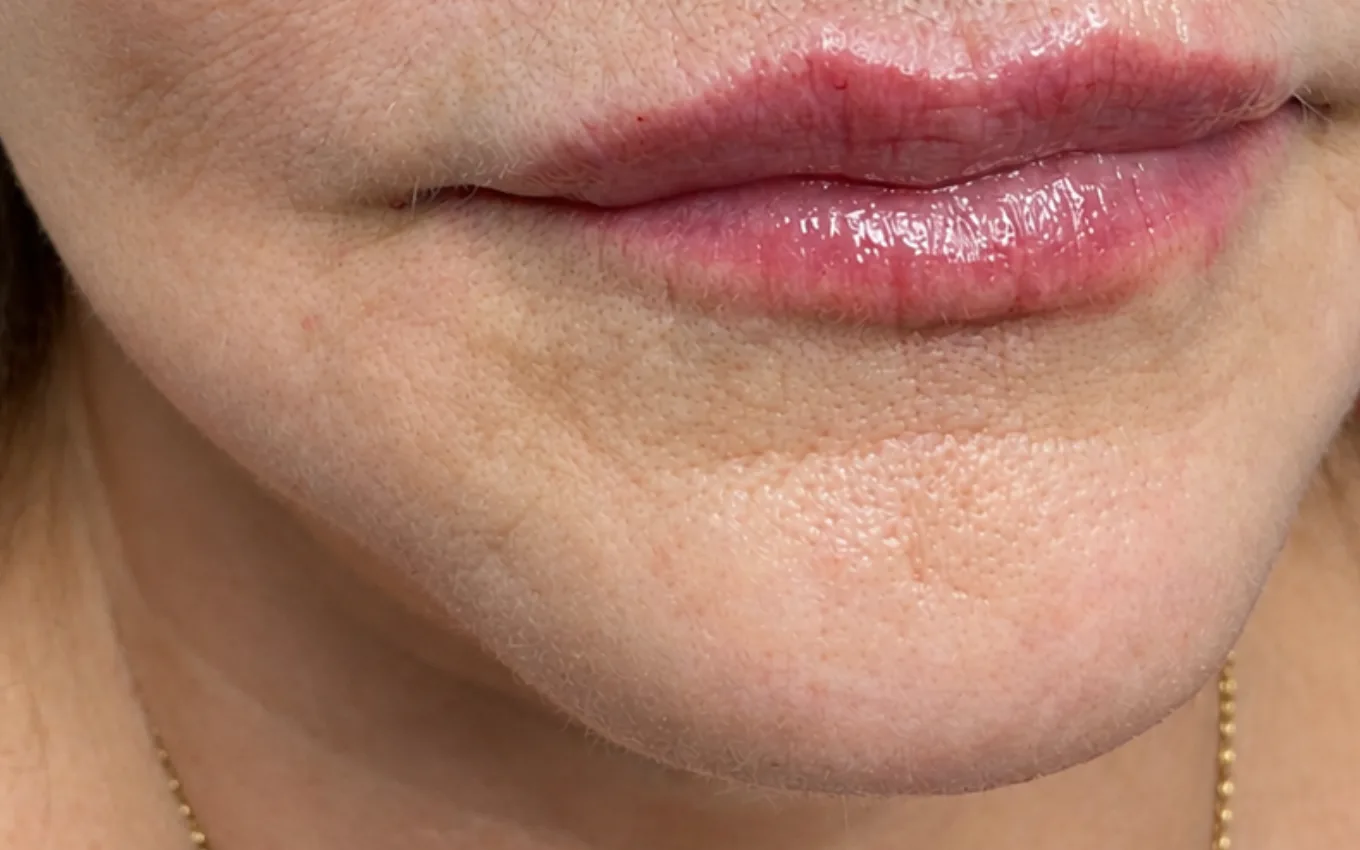 Revitalización perioral en Montevideo