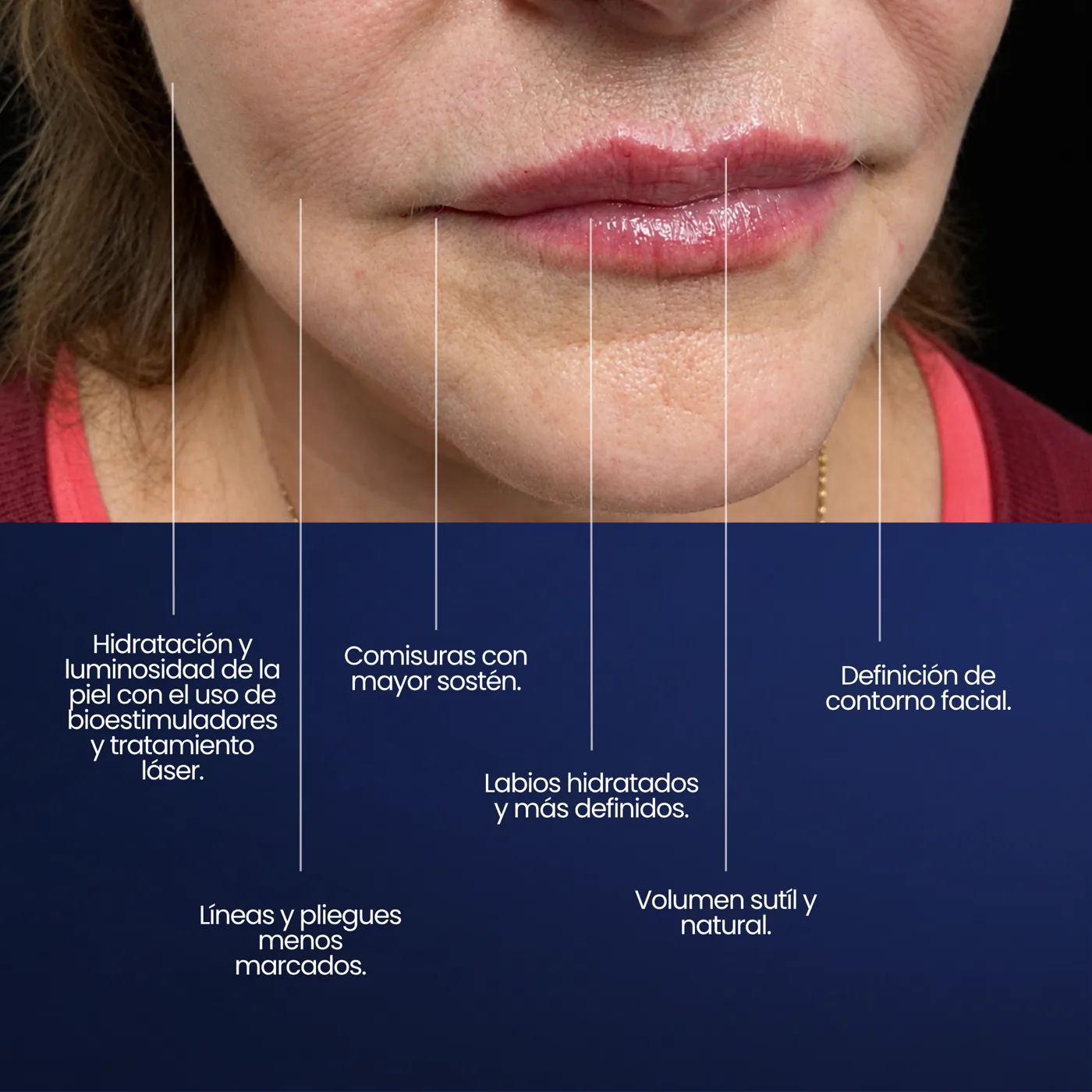 Revitalización perioral en Montevideo: hidratación, definición del contorno y líneas menos marcadas