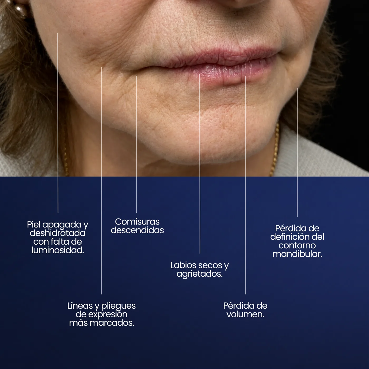 Signos de la zona perioral en Montevideo: líneas, comisuras, deshidratación y pérdida de definición